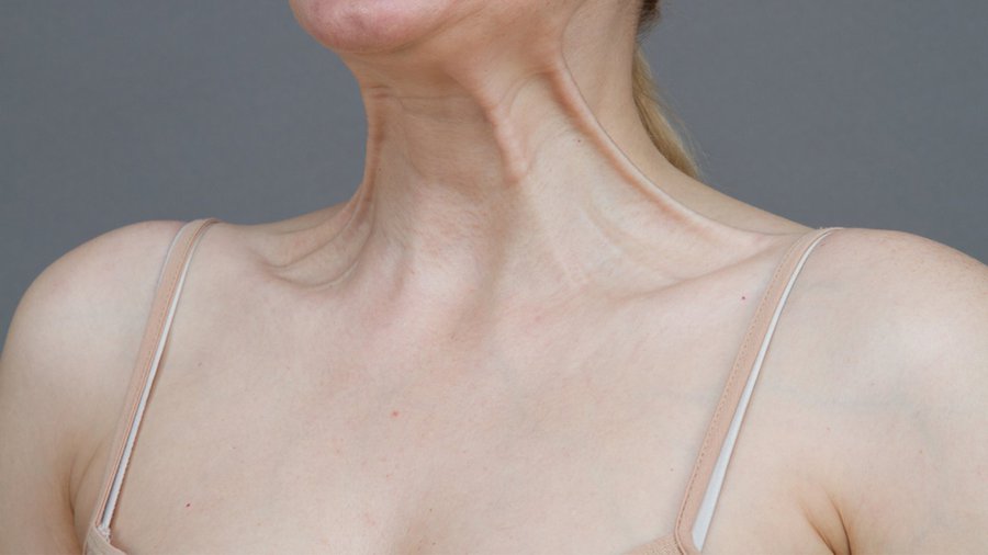 Correction of age-related changes in the neck